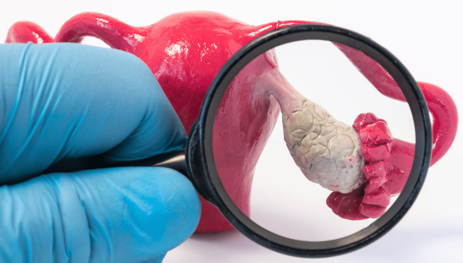 საკვერცხის სიმსივნეები  | ის, რაც უნდა ვიცოდეთ