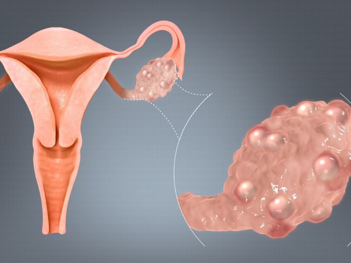 Синдром поликистоза яичников Что нам нужно знать Синево