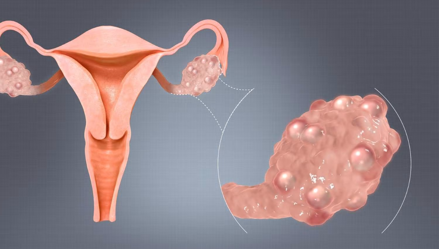 Polycystic_Ovaries პოლიცისტური საკვერცხის სინდრომი | ის, რაც უნდა ვიცოდეთ