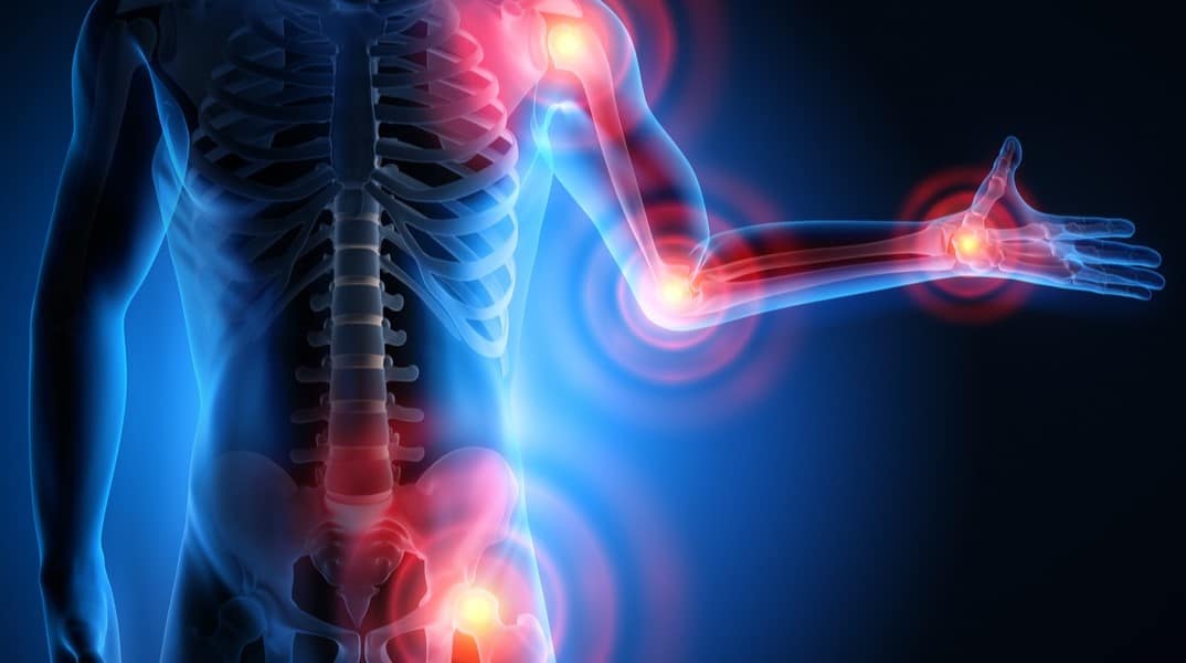 ართრიტი  | ის, რაც უნდა ვიცოდეთ