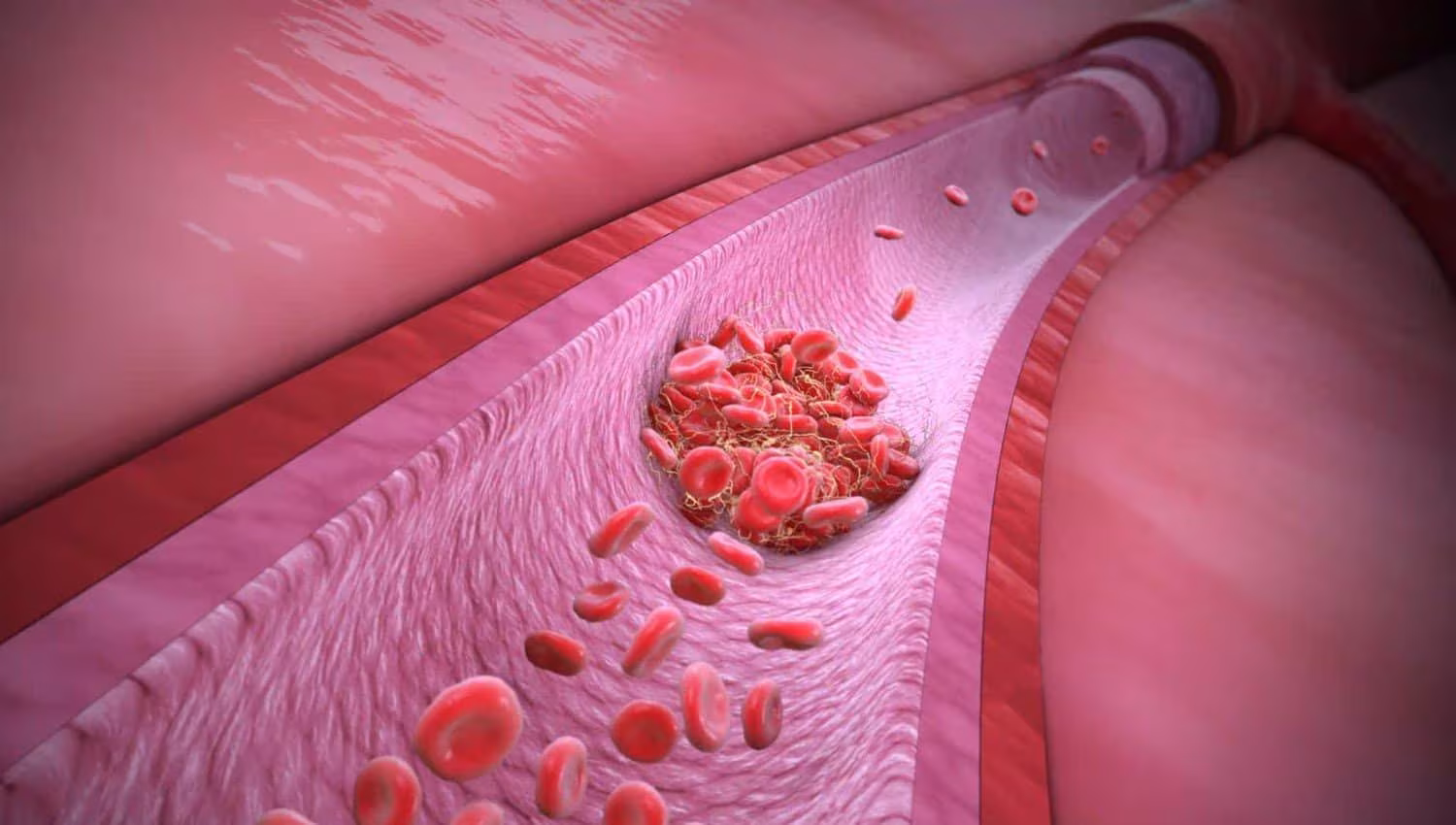 thrombophilia გენეტიკური თრომბოფილია | ის, რაც უნდა ვიცოდეთ