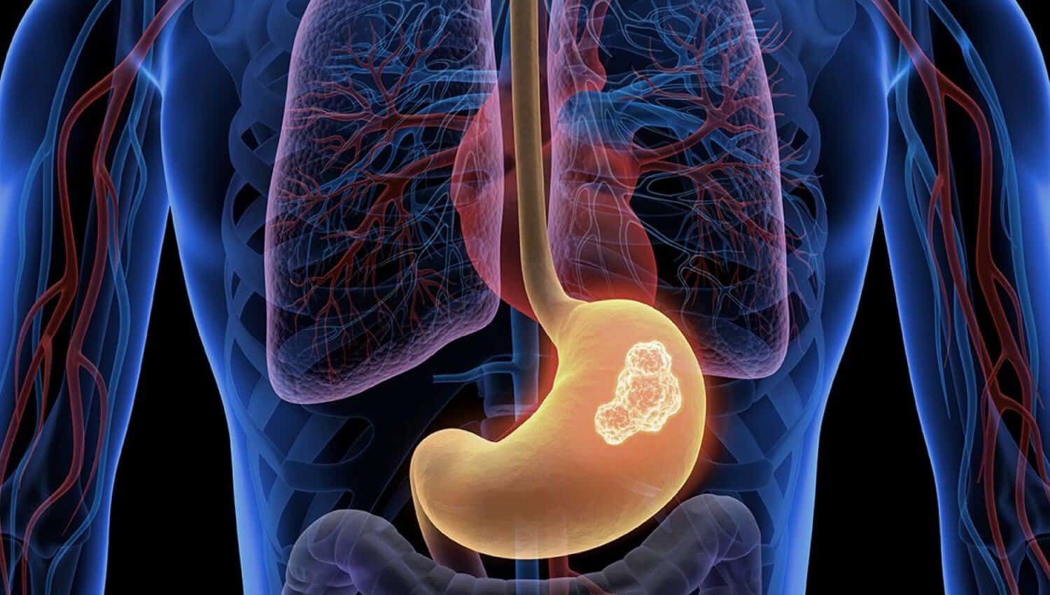 Stomach+Cancer+Surgery+Sydney+Dr+Roy+Hopkins+Upper+GI პეპტიური წყლული | ის, რაც უნდა ვიცოდეთ