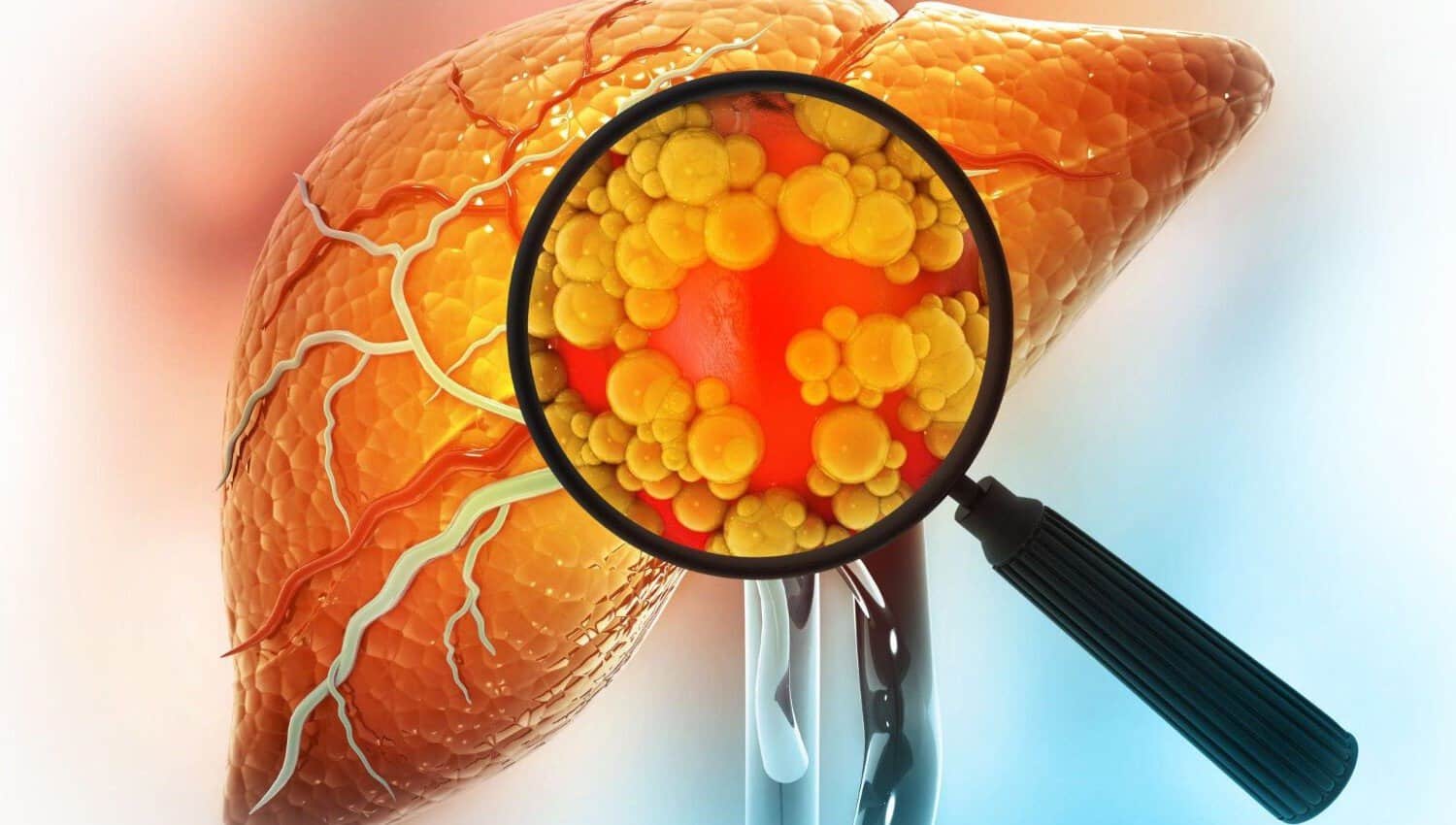 ff ღვიძლის ფიბროზი | ის, რაც უნდა ვიცოდეთ