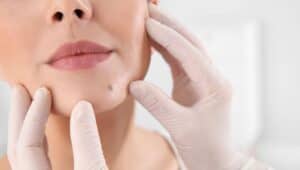 facial mole v2